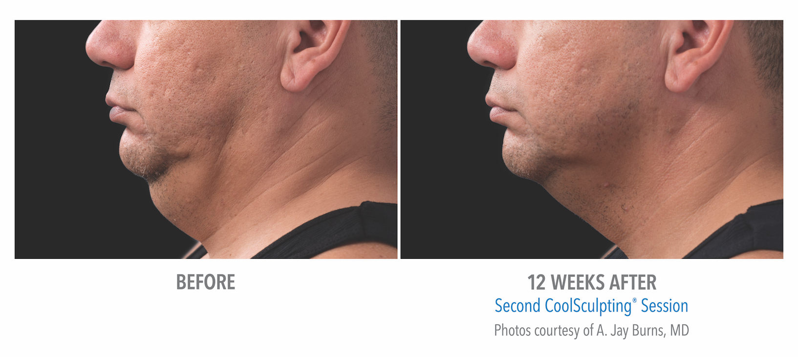 Mens Coolsculpting Before Afters Torrance Med Spa Coolsculpting