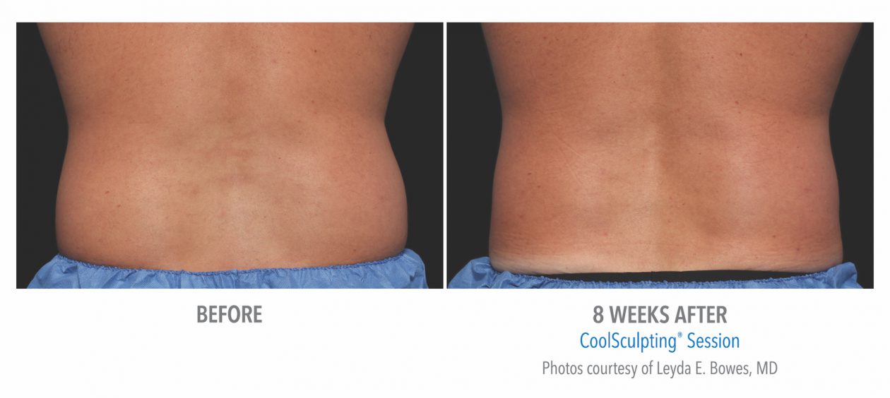 Men S Coolsculpting Before Afters Torrance Med Spa Coolsculpting