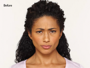 botox-before-and-after-african-american-south-bay-torrance