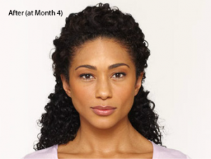 botox-before-and-after-african-american-torrance-month4