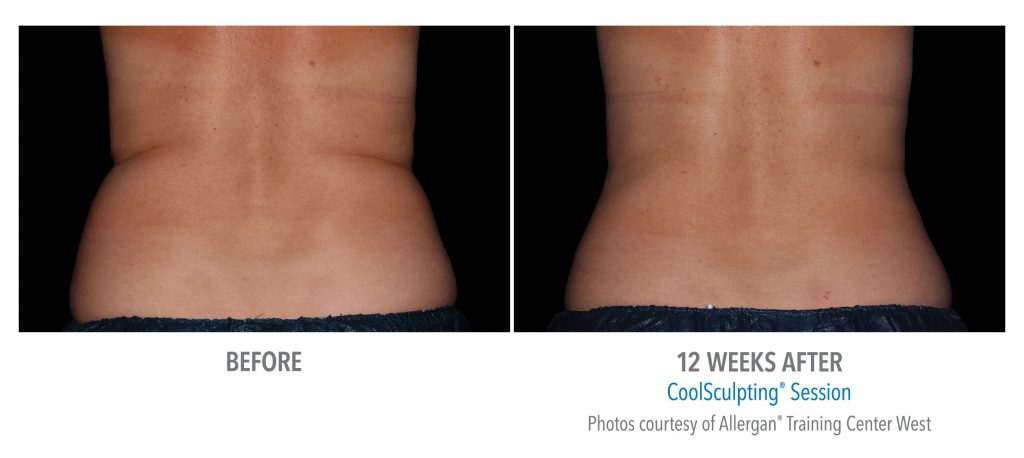 torrance-coolsculpting-back-flank-lower flank-coolsculpting