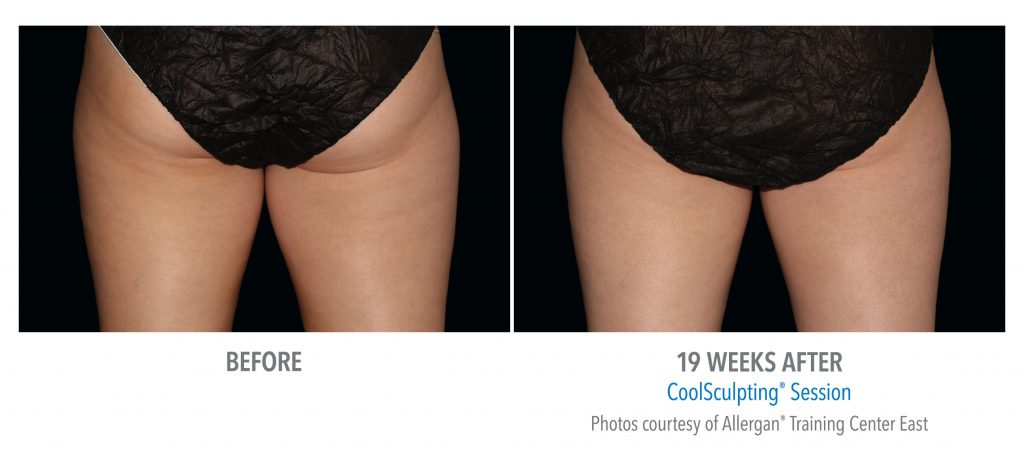 torrance-coolsculpting-thighs-inner-thigh-4