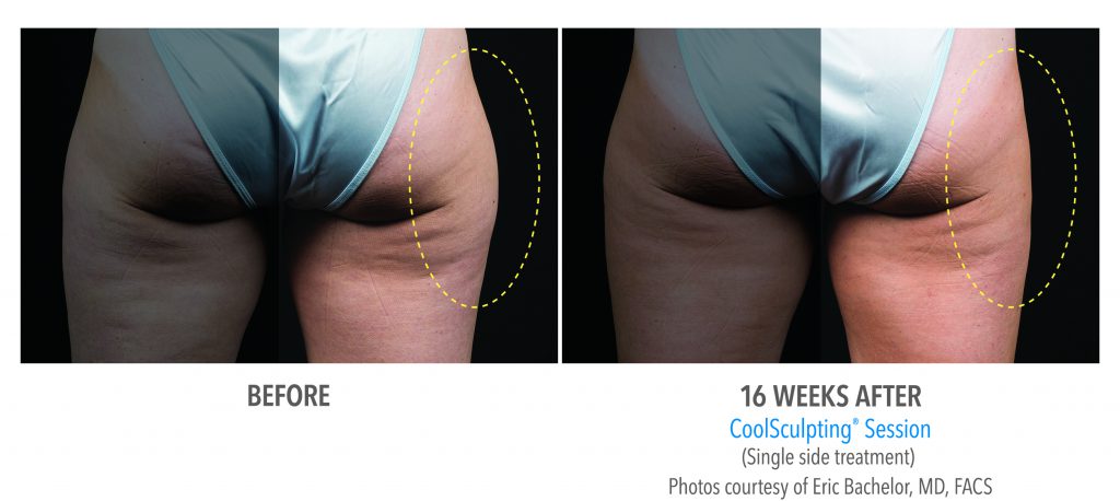 best coolsculpting near-torrance-coolsculpting-thighs-outer-thigh-1