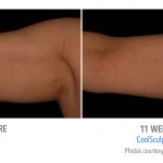 Coolsculpting arm Fat near me in Torrance