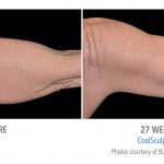 Coolsculpting arm weight loss in Torrance