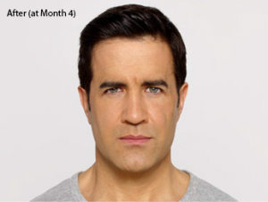 botox-before-after-caucasian-male-torrance-month4