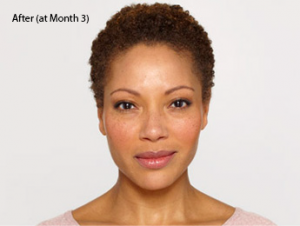 botox-before-and-after-african-american-south-bay-month3