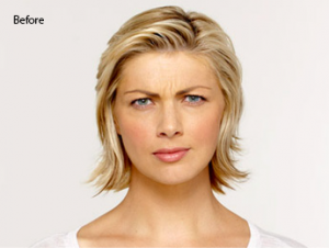 botox-before-and-after-caucasian-torrance-before