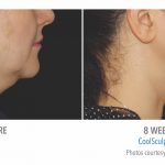 torrance-coolsculpting-under-chin-women-before-and-after
