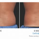 mens coolsculpting back flank in Torrance
