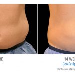 mens coolsculpting stomach flank torrance