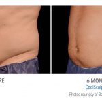 mens coolsculpting stomach in Torrance