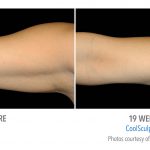 Torrance Coolsculpting arm weight loss