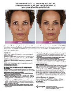 torrance-Juvederm-before-after-Michele
