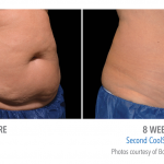 best-torrance-coolsculpting-stomach