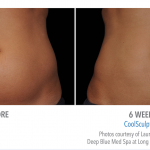 torrance-coolsculpting-stomach-weight-loss