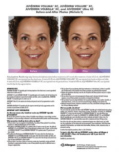 torrance-medical-Juvederm-before-after-Michele