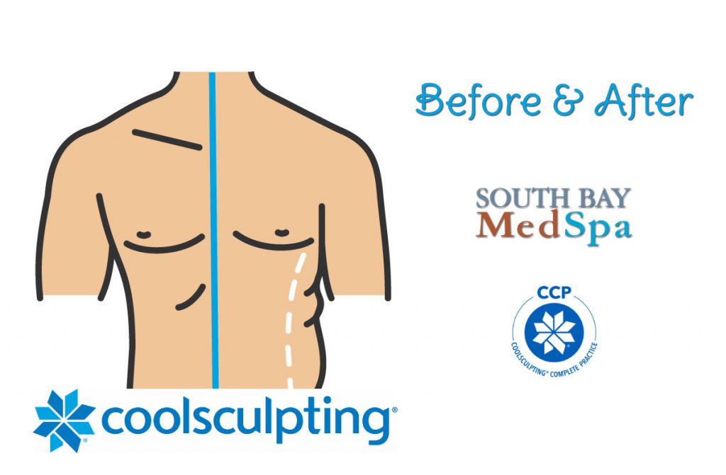 coolsculpting-mens-before-afters