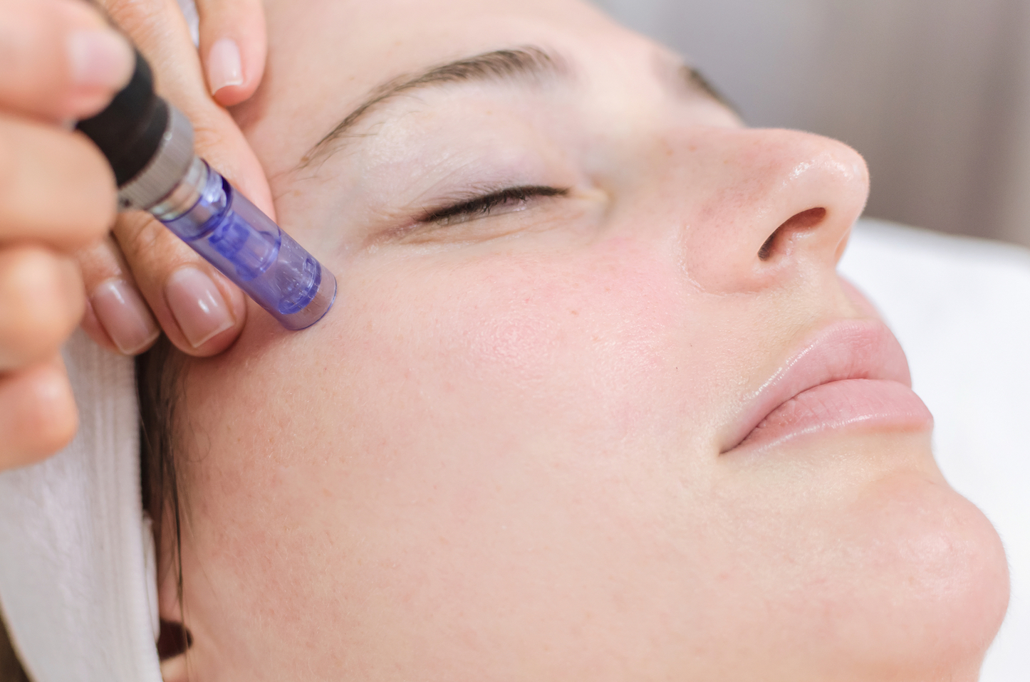 PRP Microneedling Specialist Near Me in Wappingers Falls, NY