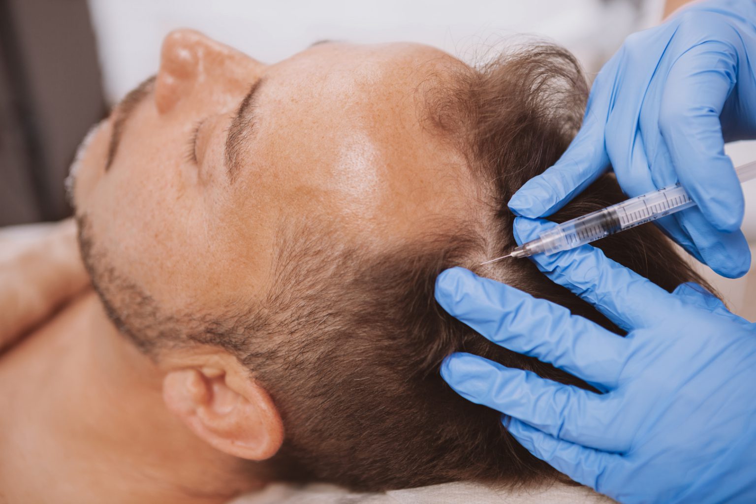 PRP Injections Torrance PRP Hair Loss Treatment Near Me Anti Aging