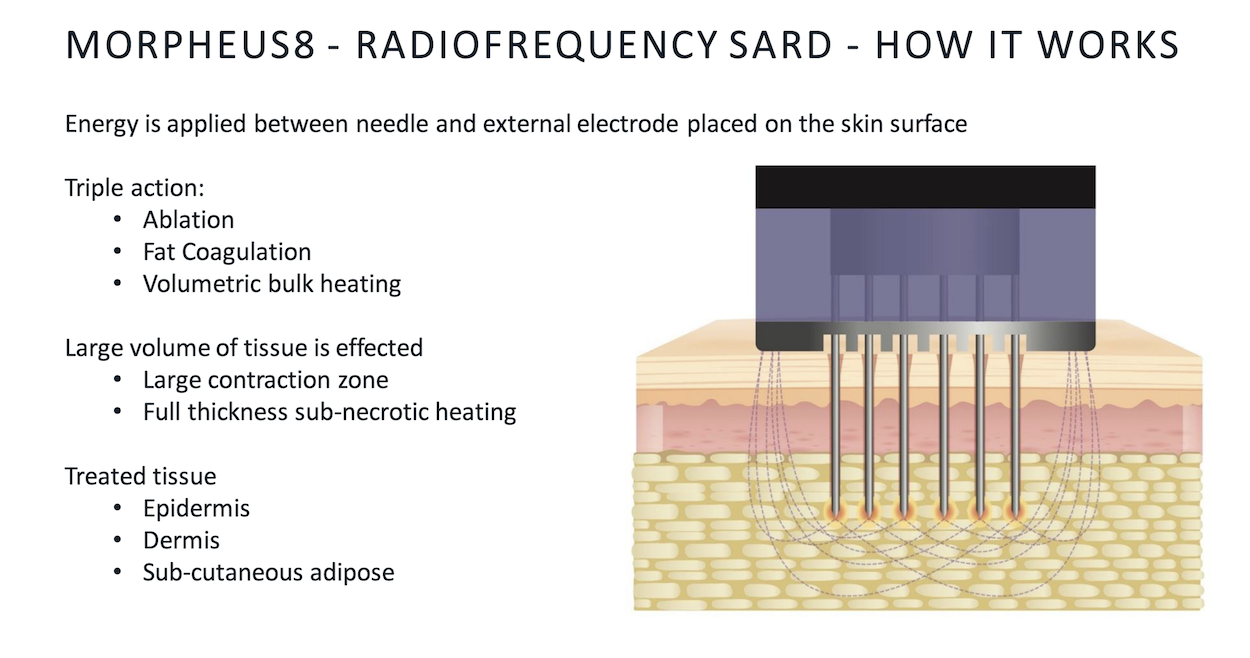 Morpheus8 | FDA-Approved Micorneedling | Free Consultation