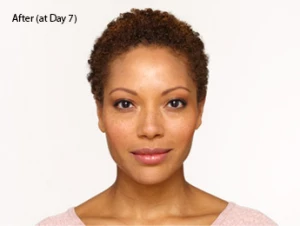botox-before-and-after-african-american-south-bay-torrance-day7